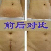 专业祛除妊娠纹（体纹）疤痕法国雅姿兰清除妊辰纹精油（30ml）-复方精油