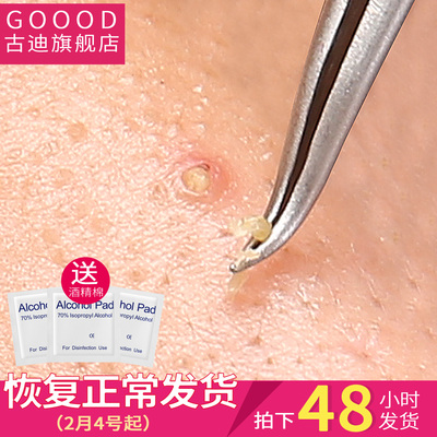 拔粉刺夹细胞夹粉刺针镊子祛痘挤痘痘去脂肪粒