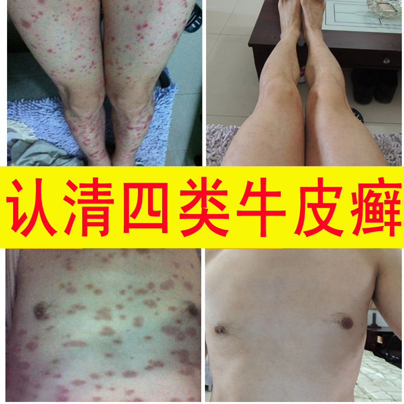quality goods Psoriasis External use Dermatitis Itching available Herb Of Tibetan Studiesin the Localization of life services , Health Services , Foot/Bath/Massage category - from Buy2taobao.com to provide professional Taobao agent buy service