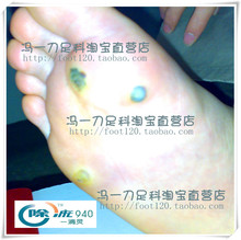 【除疣】最新最全除疣 产品参考信息