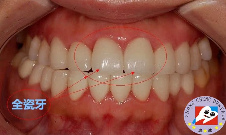 全瓷牙 北京瓷都忠诚医疗用品有限公司口腔商城 口腔器械 牙科器械 口腔材料 牙科材料 口腔设备