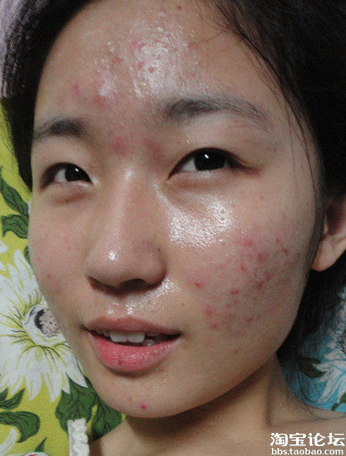 告别陪伴我将近三年的<em>痘痘</em>