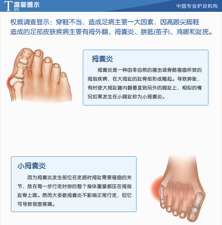 足峰正品 拇囊炎疼痛套 小拇指外翻疼痛 拇外翻脚趾疼痛 1双2只装