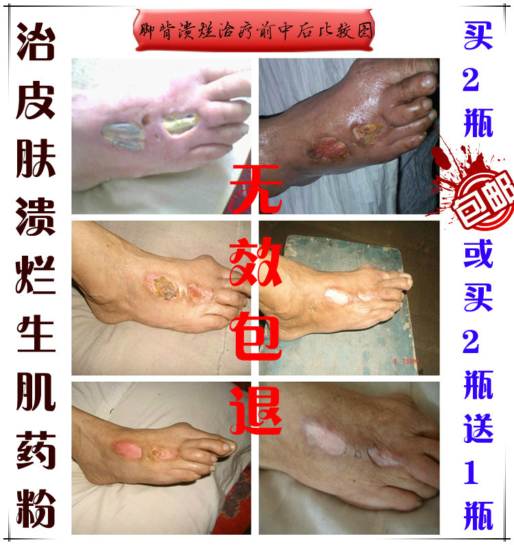 治皮肤溃烂生肌药粉治疮烂老烂脚皮肤烂放疗烂