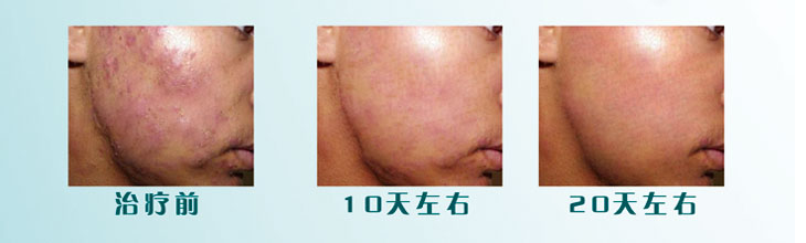 黄博士痘无痕全效美肤组合装