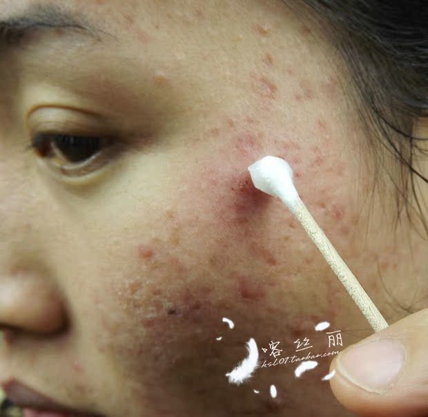 美容院专用 喀丝丽 特效清粉刺祛痘膏 拨毒 祛痘 修复 清粉刺_美容院专用 喀丝丽 特效清粉刺祛痘膏 拨毒 祛痘 修复 清粉刺价格_美容院专用 喀丝丽 特效清粉刺祛痘膏 拨毒 祛痘 修复 清粉刺图片_淘宝__