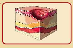 伤口不愈合_伤口化脓_伤口感染_伤口愈合慢_